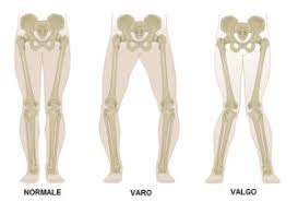 ginocchia vare valghe - egovaleo.org